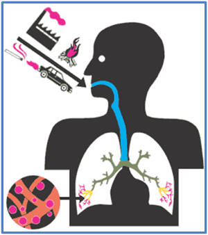 Die Grafik zeigt, was alles in die Lungenbläschen gelangen kann. Das Gefahrenpotential der einzelnen Faktoren ist unterschiedlich. Feinstäube sind besonders gefährlich, weil sie sich in den Lungenbläschen anreichern und von da nicht mehr weg können: Grundlage für die Entstehung von Atemwegserkrankungen und Krebs.